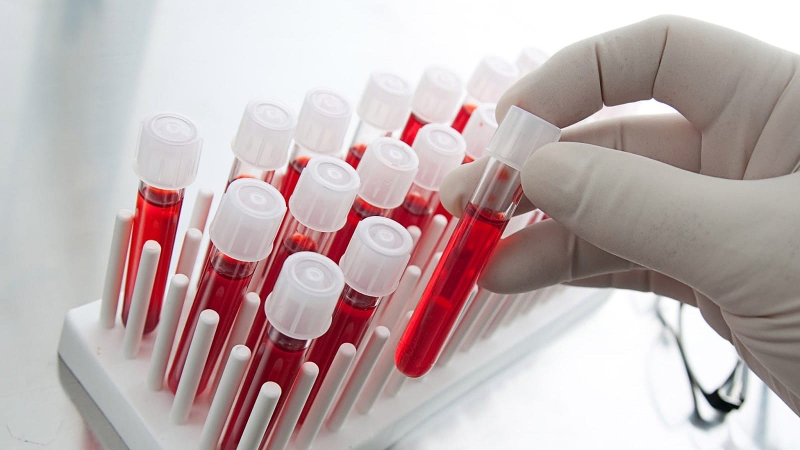 В 2023 году ФОМС выделил почти 30 млн сомов на покупку крови для детей с гемофилией